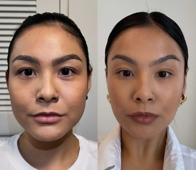 Non-surgical care using Botox for TMJ and Bruxism Treatments to manage bruxism symptoms.