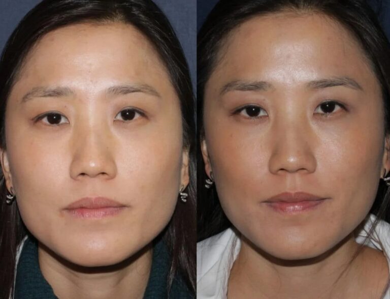 Pain relief achieved with Botox for TMJ and Bruxism Treatments targeting overactive jaw muscles.