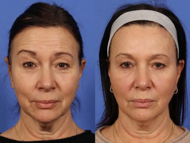 Full Face Btx Before and After