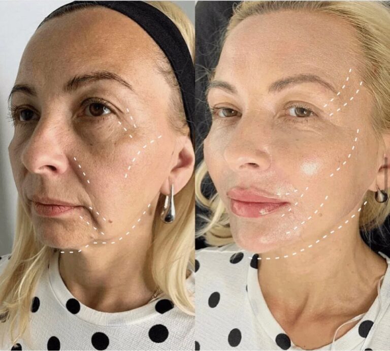 Full Face Btx Treatment Results
