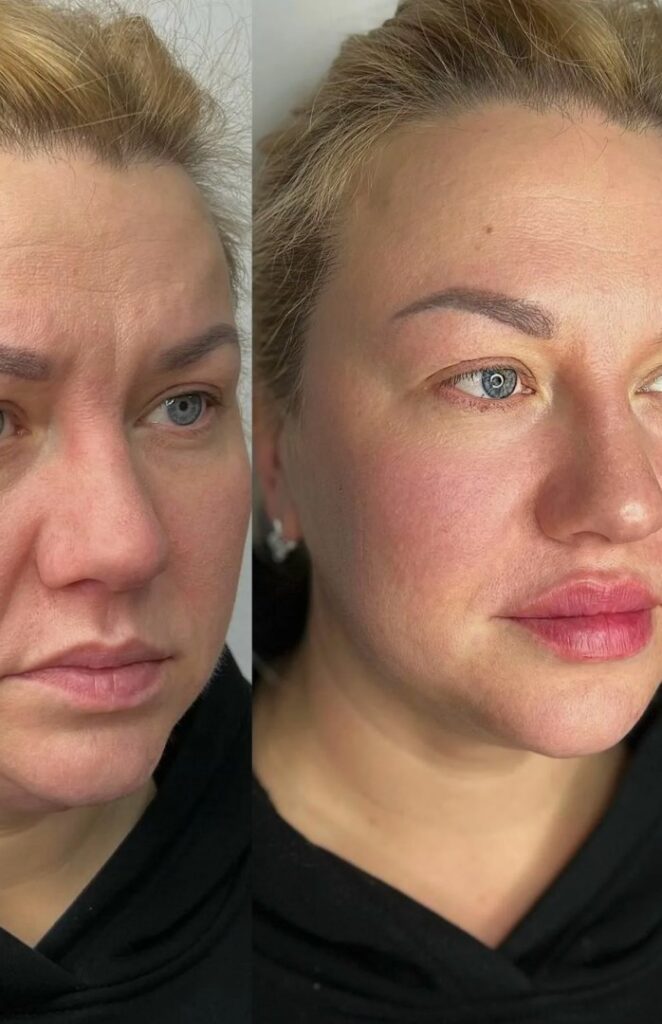 Advanced Full Face Btx treatment focused on overall facial balance and smooth, natural-looking skin.