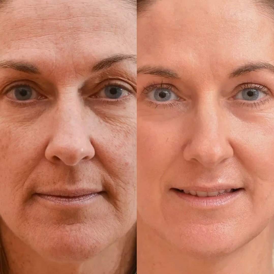 Full Face Botox Treatment London Price 500 Before After Full Face Botox Treatment London Price 500 Before After
