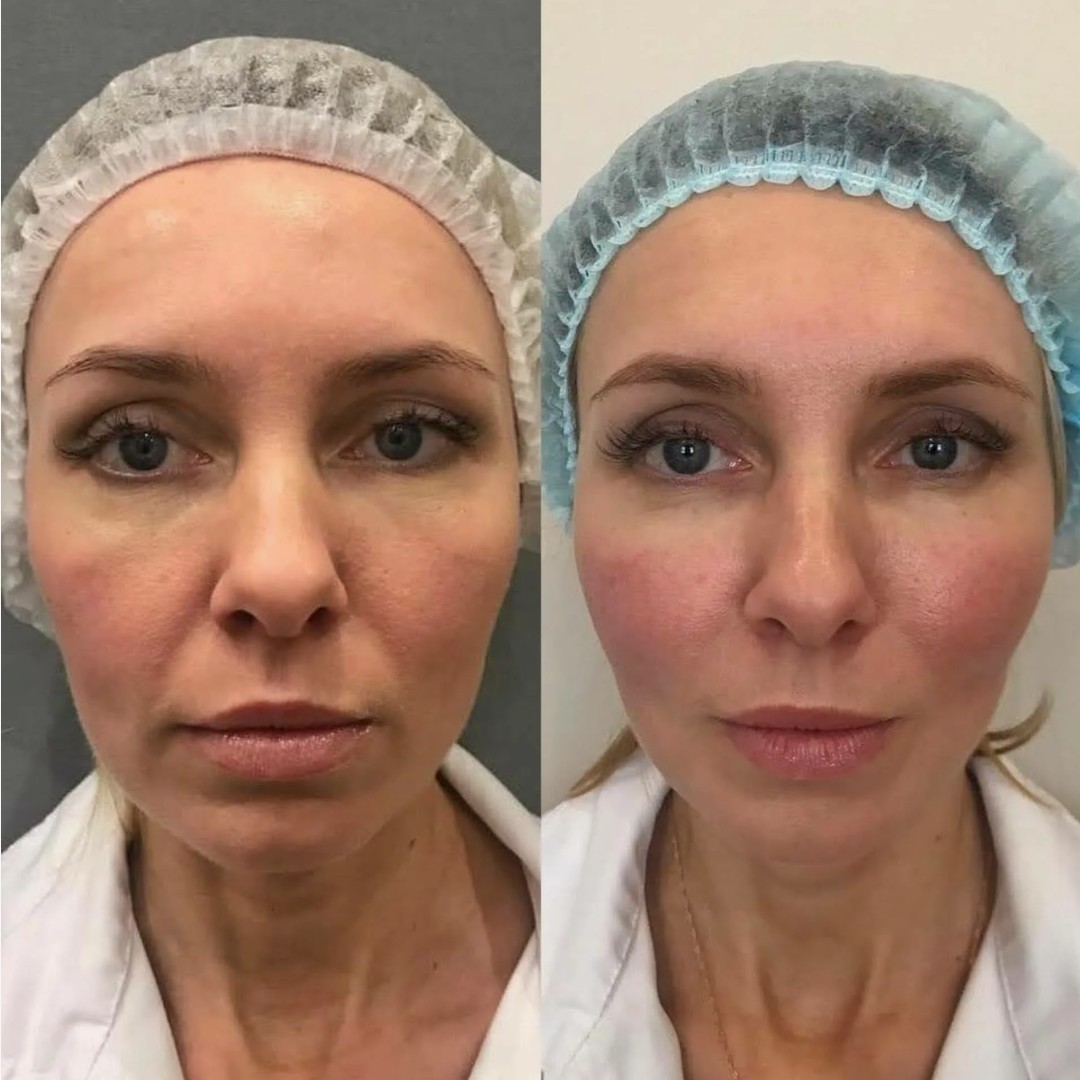 Facial rejuvenation achieved with Full Face Btx for a refreshed and well-rested appearance.
