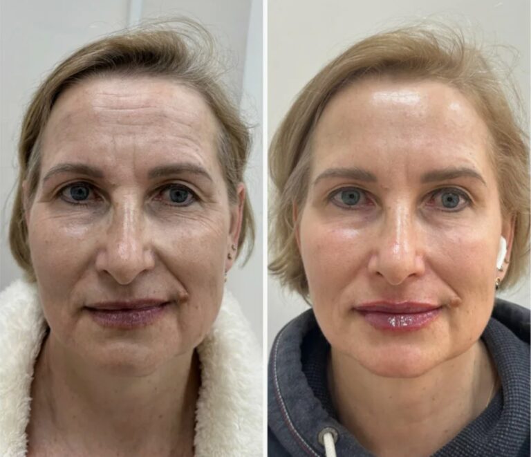 Full Face Btx Injection Plan