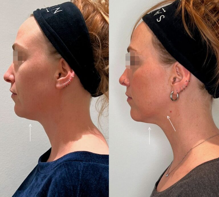 Natural-looking results of Full Face Btx while preserving facial expressions and individuality.