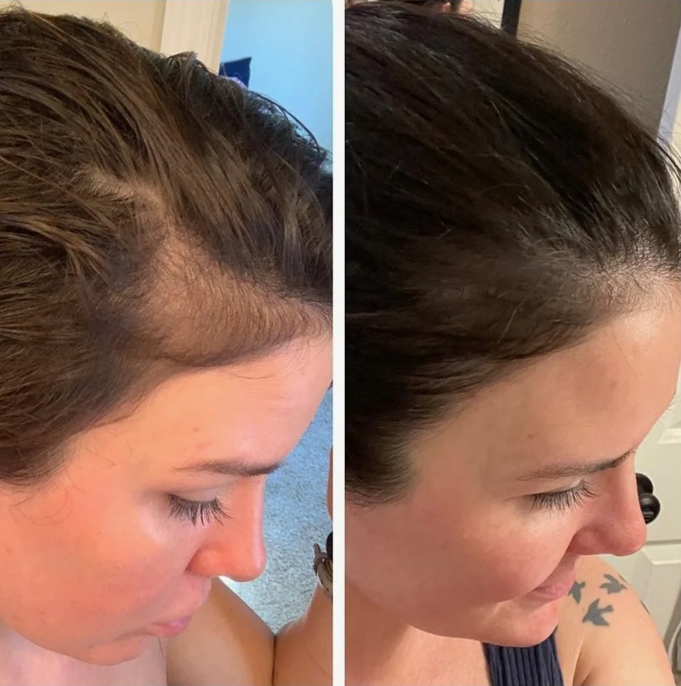 Natural-looking results of Hair Filler designed to improve hair strength without artificial appearance.