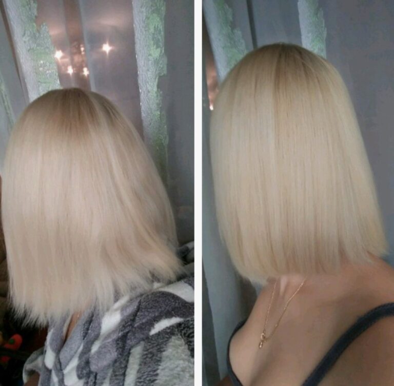 Scalp rejuvenation achieved with Hair Filler to support healthier-looking and stronger hair.