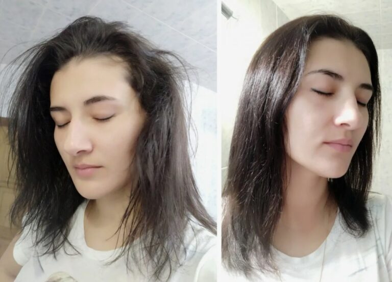 Visible results of a Hair Filler treatment improving hair density and overall scalp appearance.