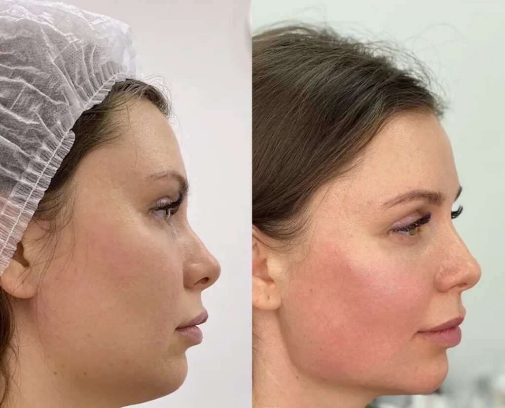 Subtle aesthetic results achieved with Jawline Filler for a refined and sculpted jawline. Название: Jawline Filler Non-Surgical Contouring