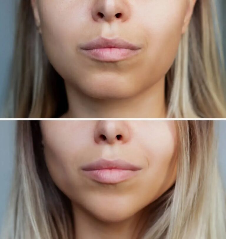 Jawline Filler treatment designed to enhance facial harmony and improve overall profile aesthetics.
