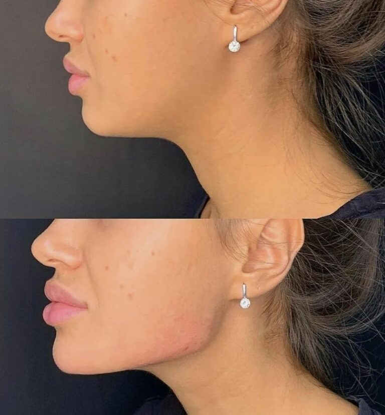 Close-up view of the Jawline Filler injection technique performed to achieve natural-looking definition.