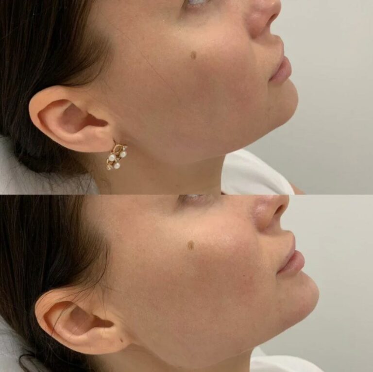 Professional Jawline Filler contouring focused on creating a structured, well-defined lower face.