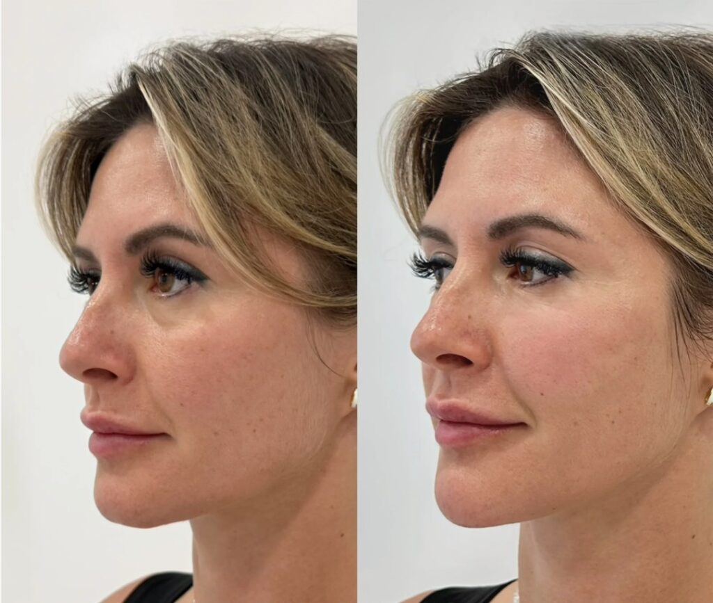 Visual results of a Jawline Filler procedure showing enhanced jaw definition and balanced facial contours.