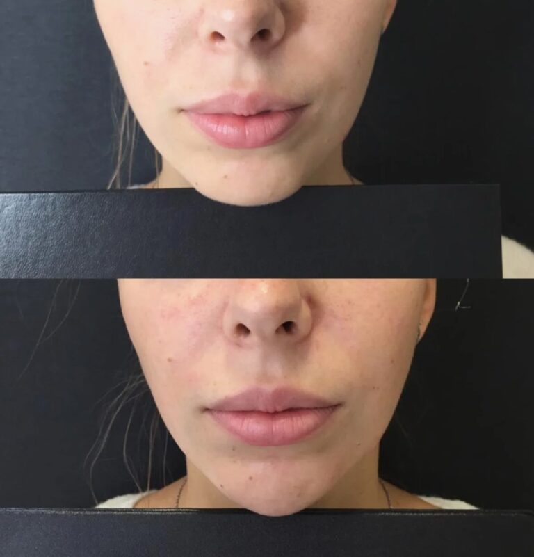 Before and after comparison demonstrating how Jawline Filler improves jawline sharpness and facial symmetry.