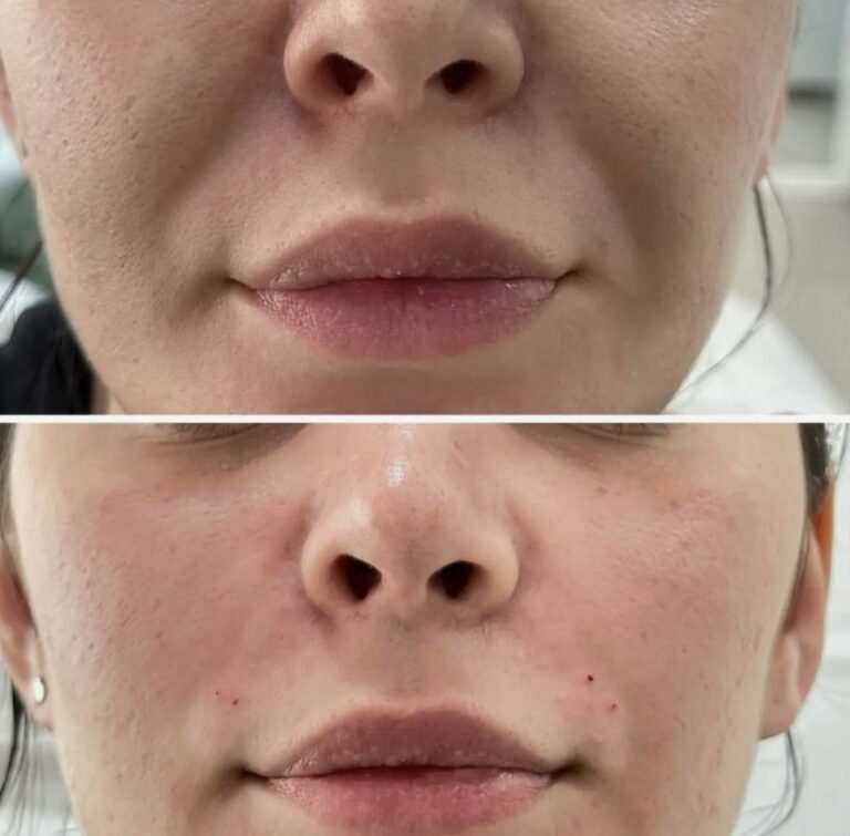 Natural-looking results of Nasolabial Fold Filler designed to enhance facial softness without overcorrection.