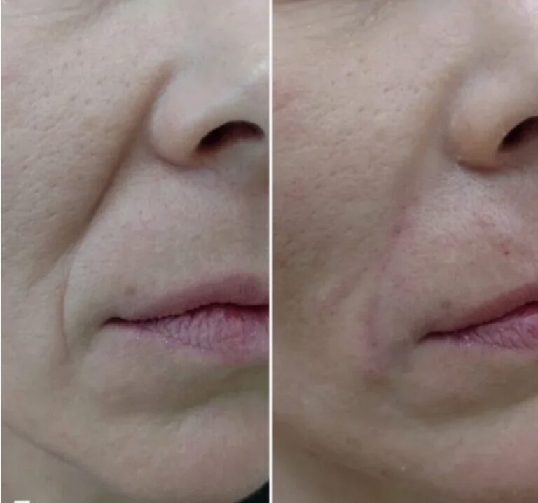 Non-surgical correction of smile lines using Nasolabial Fold Filler with subtle and balanced results.