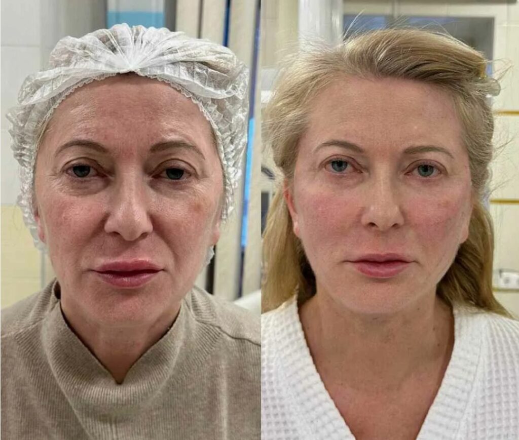 Visible results of a Nasolabial Fold Filler treatment reducing deep smile lines and refreshing facial appearance.