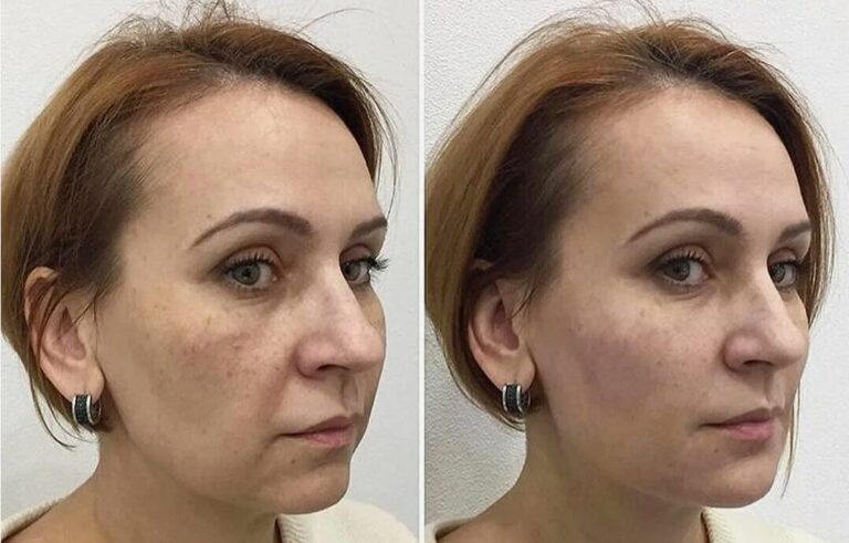 Detailed aesthetic planning involved in a Profile Balancing Procedure to achieve natural results.