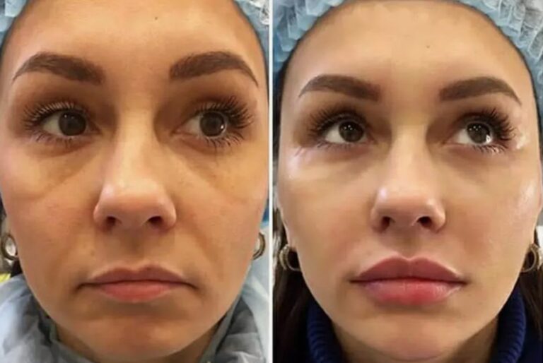 Precision injection technique used during a Profile Balancing Procedure to maintain facial symmetry.