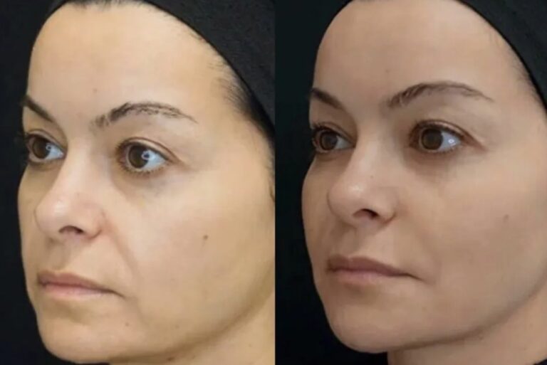 Non-surgical Profile Balancing Procedure aimed at improving facial balance without invasive methods.