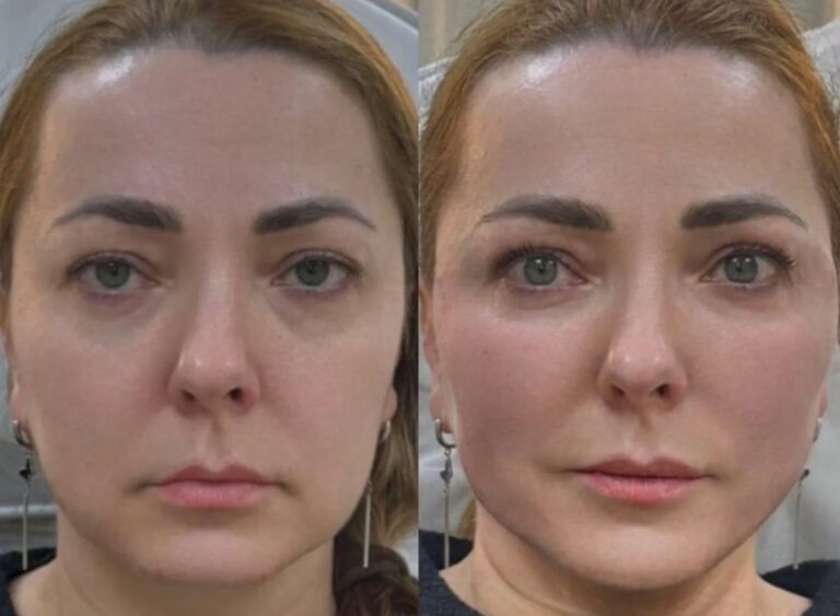 Side profile enhancement achieved through a Profile Balancing Procedure focused on subtle refinement.