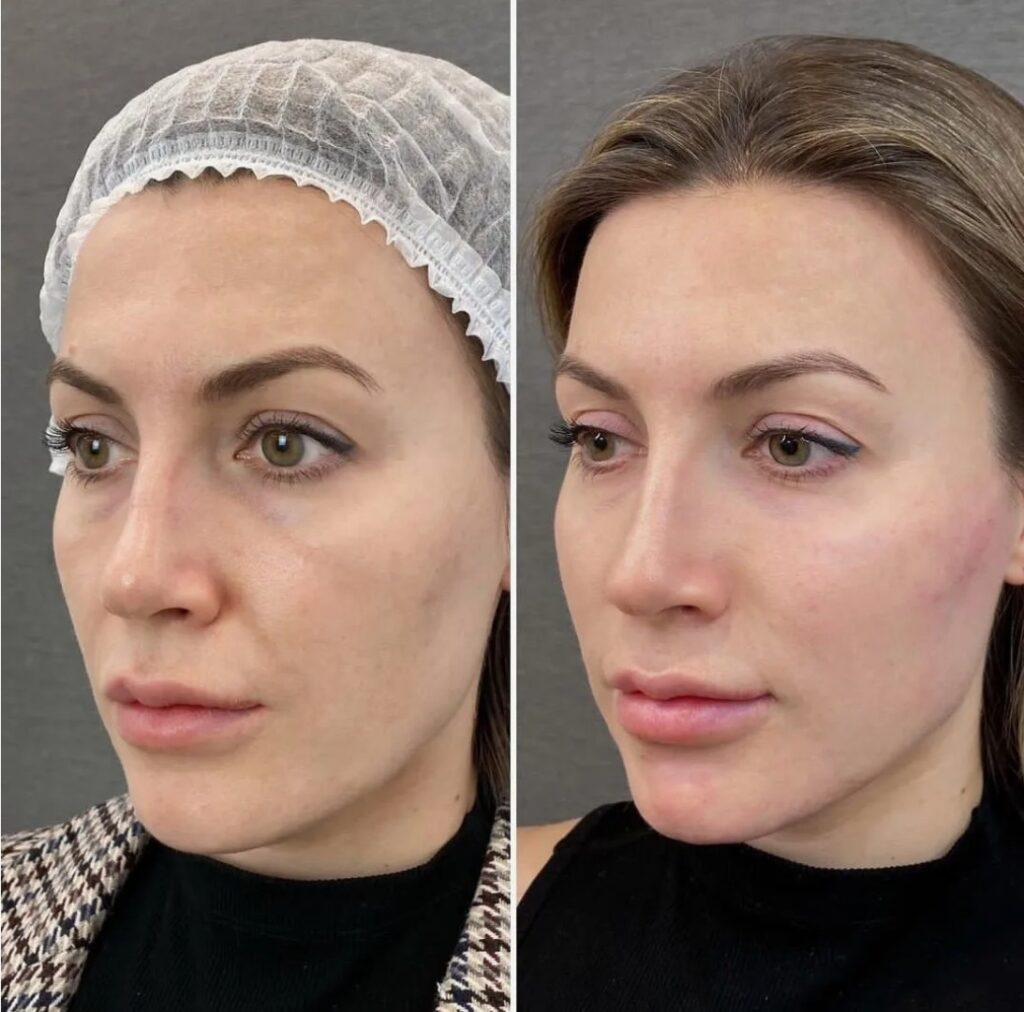 Visible results of a Profile Balancing Procedure enhancing facial proportions and overall harmony.