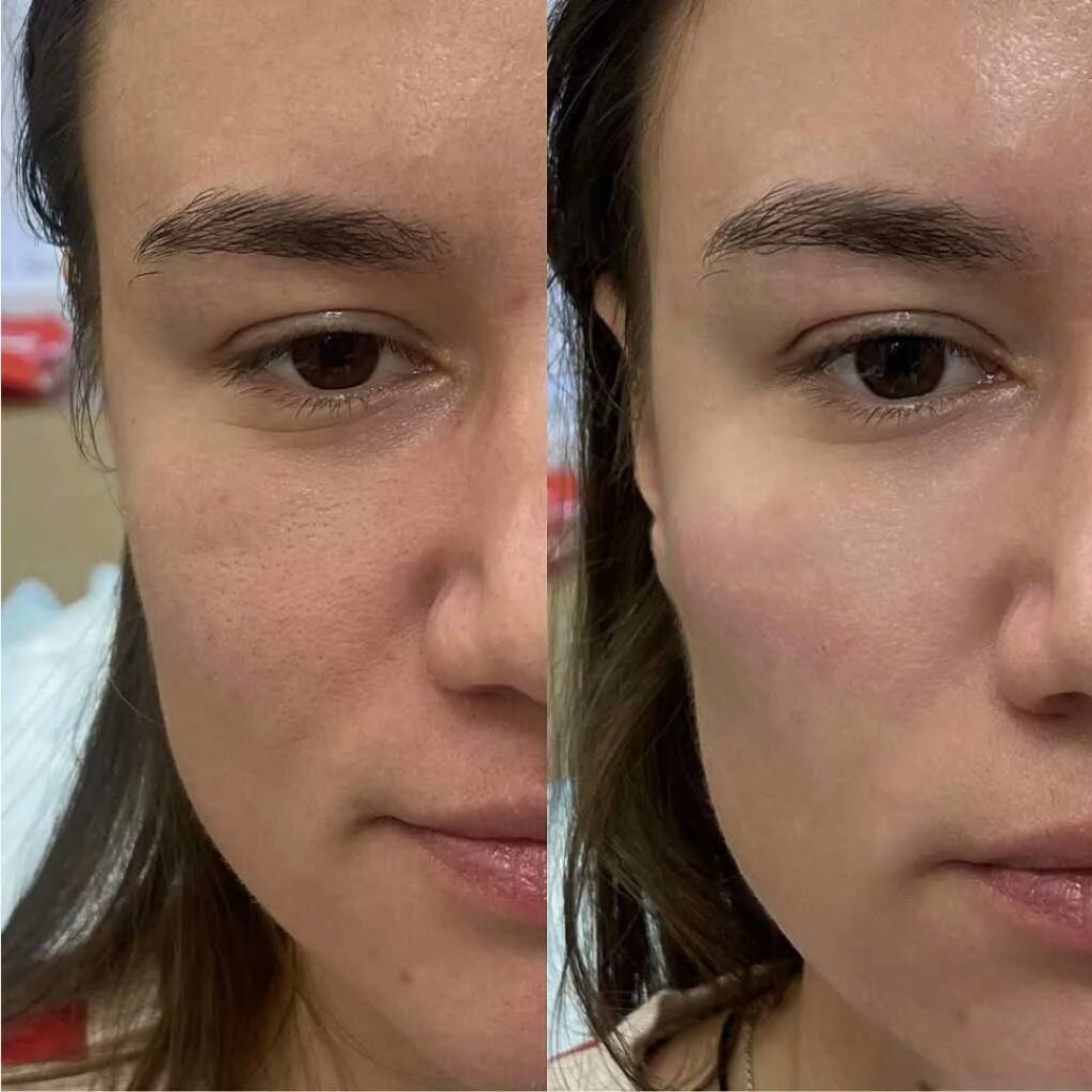 Advanced aesthetic treatment with Radiesse Filler focused on long-term firmness and natural results.