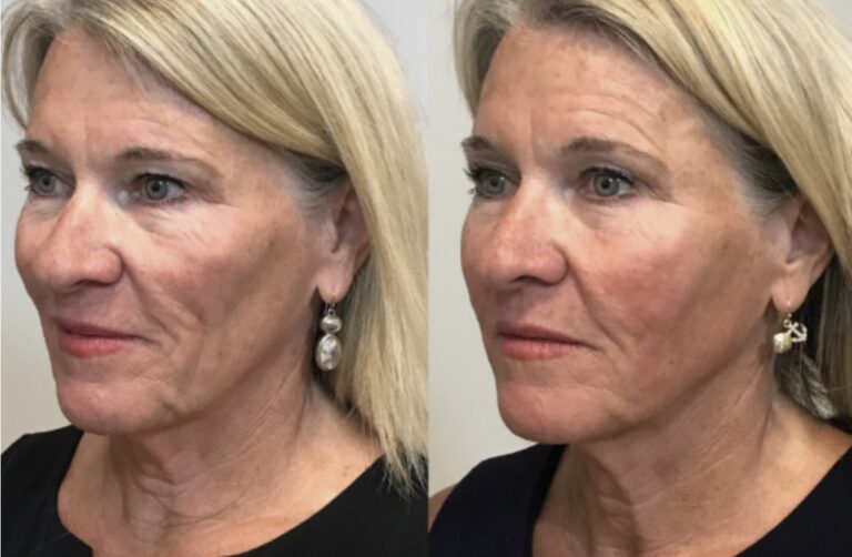 Radiesse Filler Collagen Stimulation