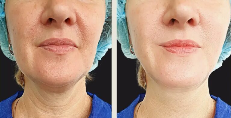 Facial rejuvenation using Radiesse Filler to restore volume and improve skin elasticity.