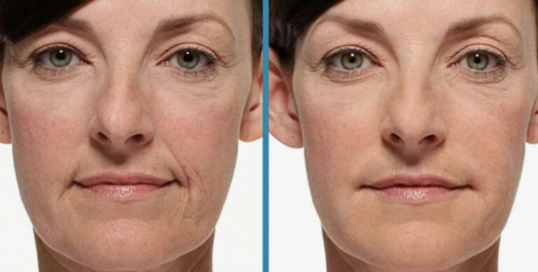 Precise Radiesse Filler injection technique focused on safety, structure, and natural-looking results.