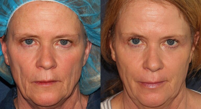 Natural and long-lasting results achieved with Radiesse Filler while preserving facial harmony.