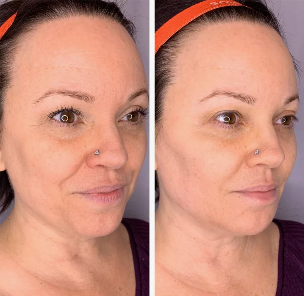 Structural enhancement using Radiesse Filler to support facial contours and improve skin density.