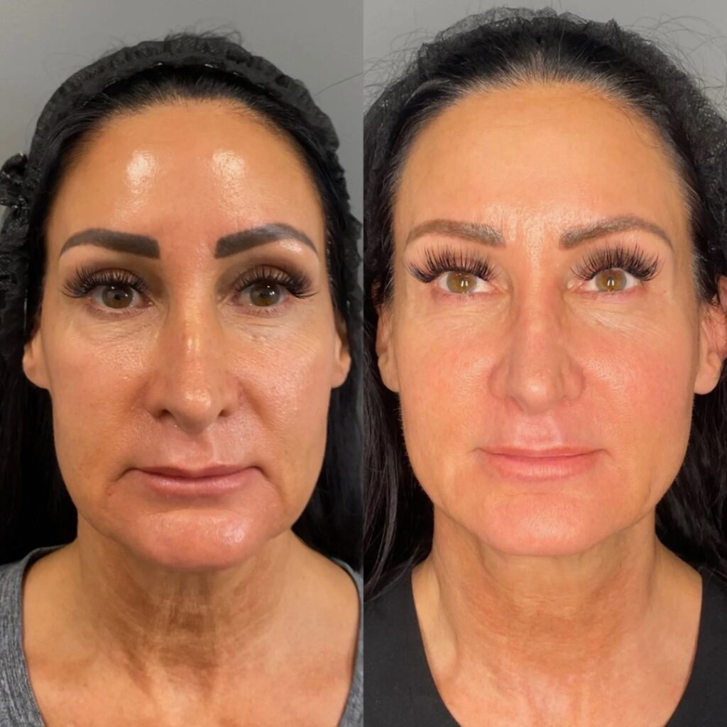 Visible results of a Radiesse Filler treatment enhancing facial structure and skin quality.