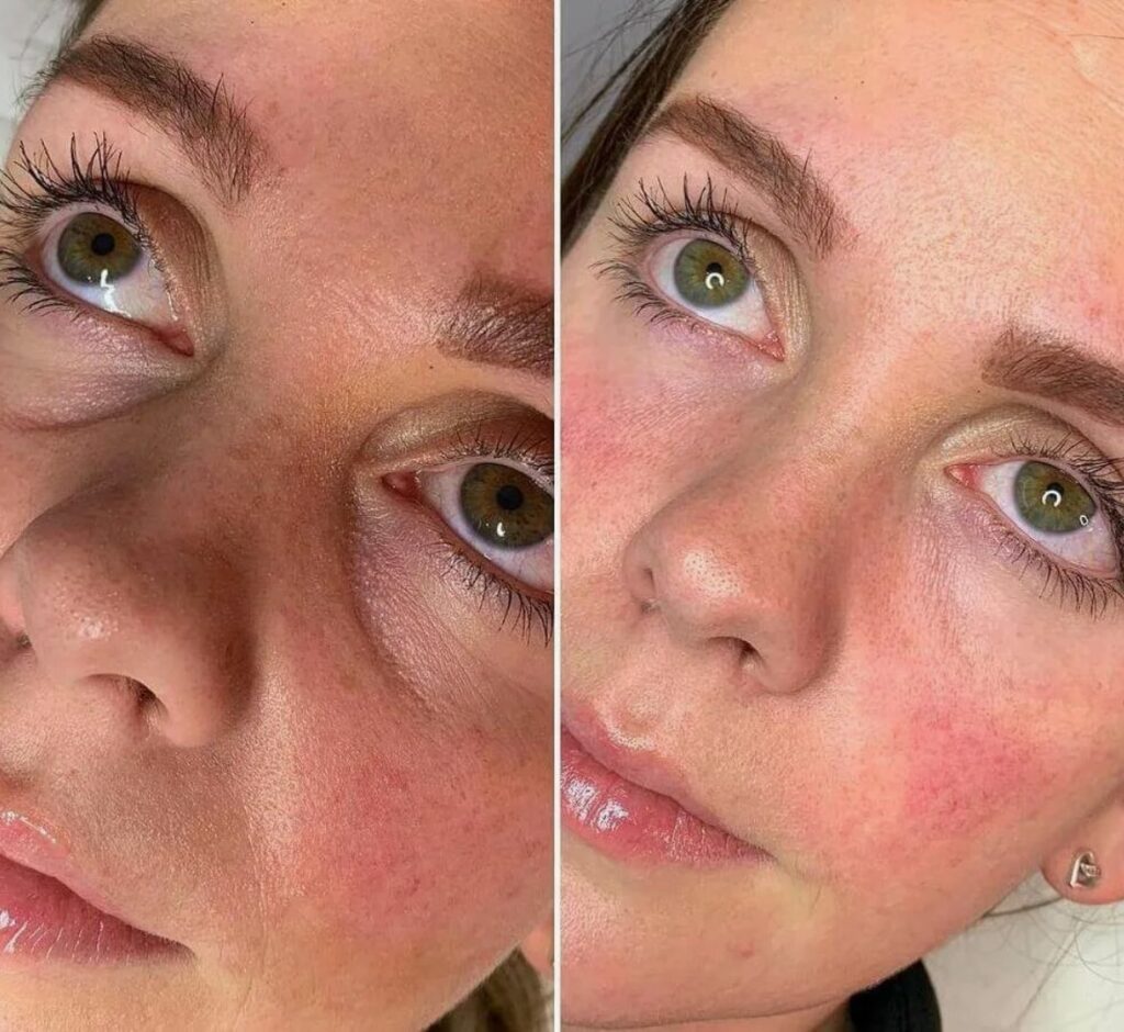 Before and after comparison showing how Tear Trough Filler smooths under-eye shadows and improves skin appearance.