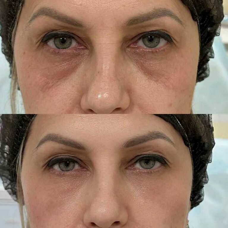 Expert-performed Tear Trough Filler treatment highlighting precision, safety, and aesthetic balance.