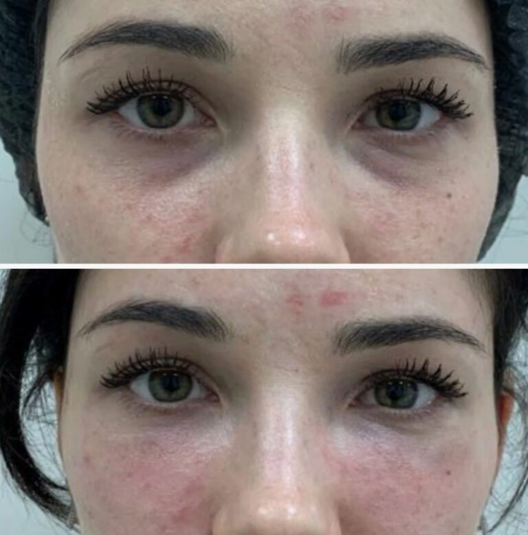 Precise Tear Trough Filler injection technique focused on safety, balance, and natural results.