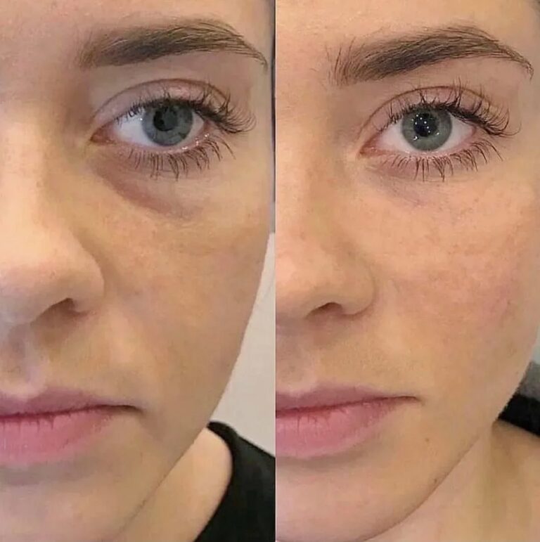 Subtle and natural results achieved with Tear Trough Filler while preserving facial harmony.