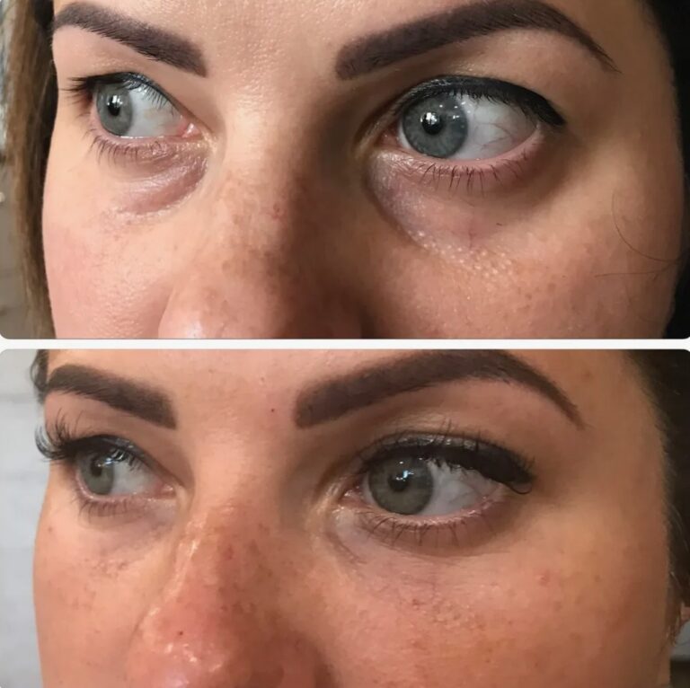 Non-surgical rejuvenation of the under-eye area with Tear Trough Filler for a fresher, brighter look.