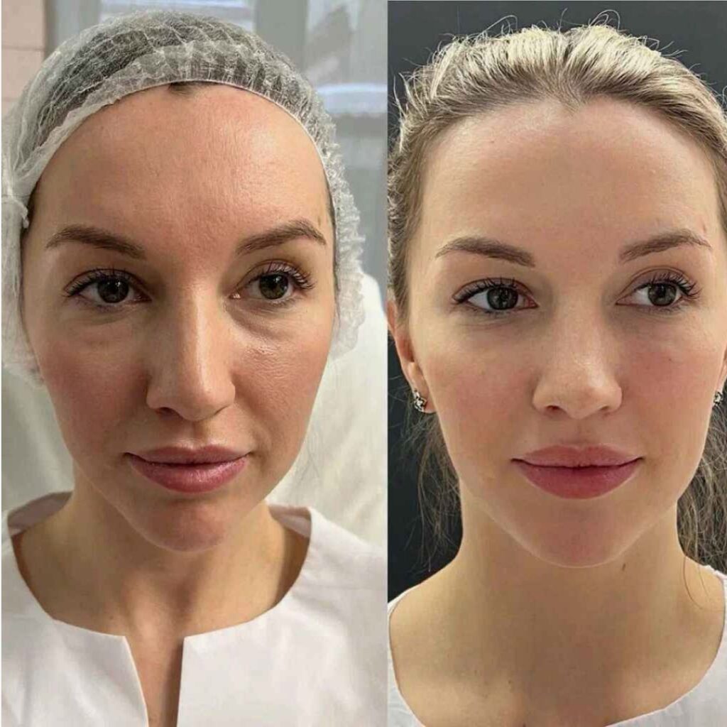 Visible results of a Tear Trough Filler treatment reducing under-eye hollows and refreshing the eye area.