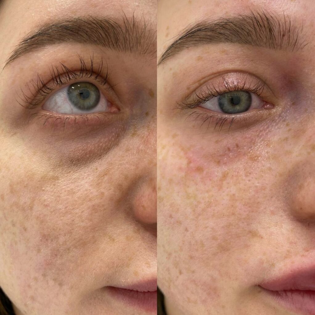 Targeted under-eye correction using Tear Trough Filler to restore volume and soften tired-looking eyes.