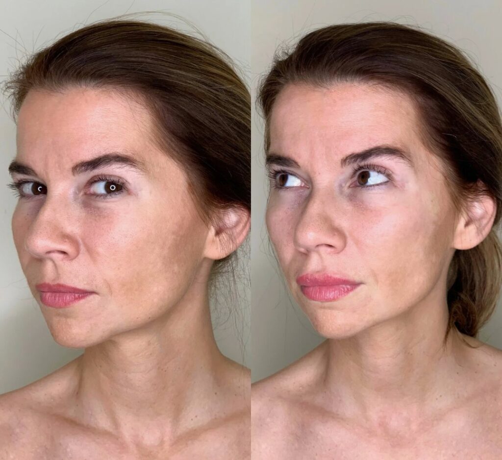 Before and after comparison showing how Temple Fillers correct hollow temples and soften facial contours.