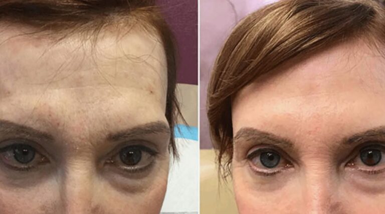 Expert-performed Temple Fillers treatment highlighting precision, safety, and aesthetic balance.