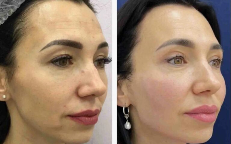 Subtle, natural-looking results achieved with Temple Fillers while preserving facial harmony.