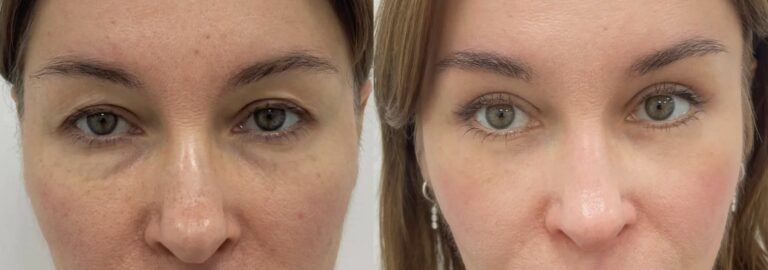 Temple Fillers Non-Surgical Correction