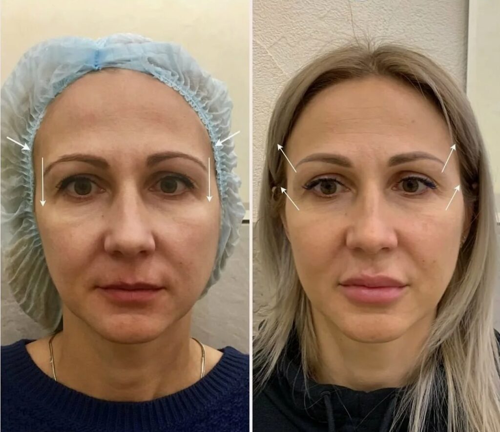 Visible results of Temple Fillers restoring volume and improving overall facial balance.
