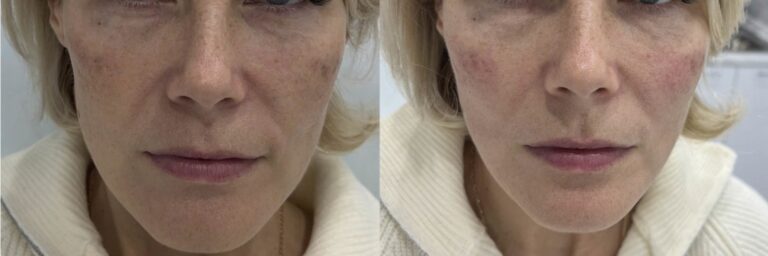 Cheek filler before after with improved cheek volume and smoother facial contours.