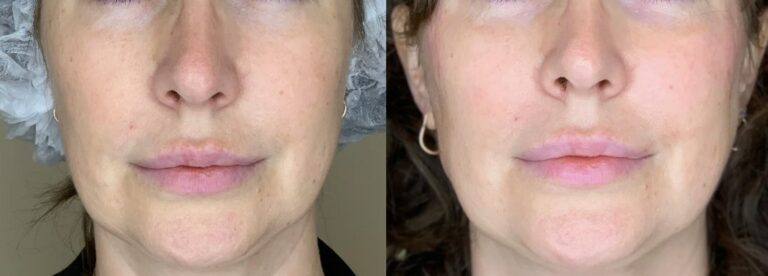 Cheek filler treatment before after enhancing mid face volume and facial harmony.