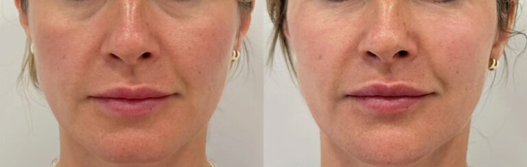 Cheek filler aesthetic correction before after with lifted cheeks and refreshed look.