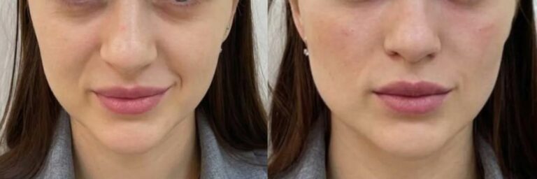 Cheek filler results before after with natural volume restoration and improved facial contours.