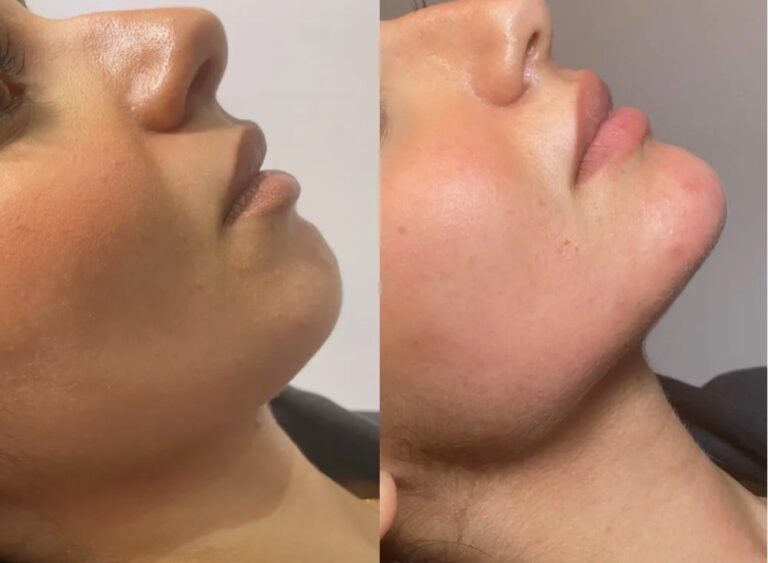 Chin fillers aesthetic enhancement before after with more defined lower face.